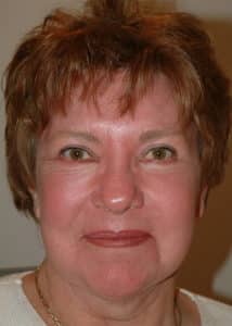 Upper & Lower Blepharoplasty, Facelift, Necklift and Full Face Laser Resurfacing