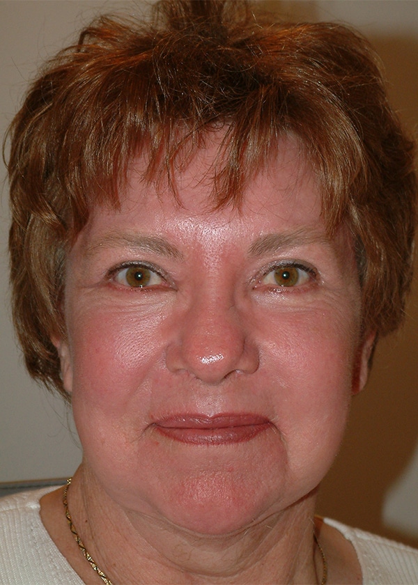 After Image: Upper & Lower Blepharoplasty, Facelift, Necklift and Full Face Laser Resurfacing - front