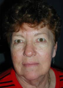 Upper & Lower Blepharoplasty, Facelift, Necklift and Full Face Laser Resurfacing