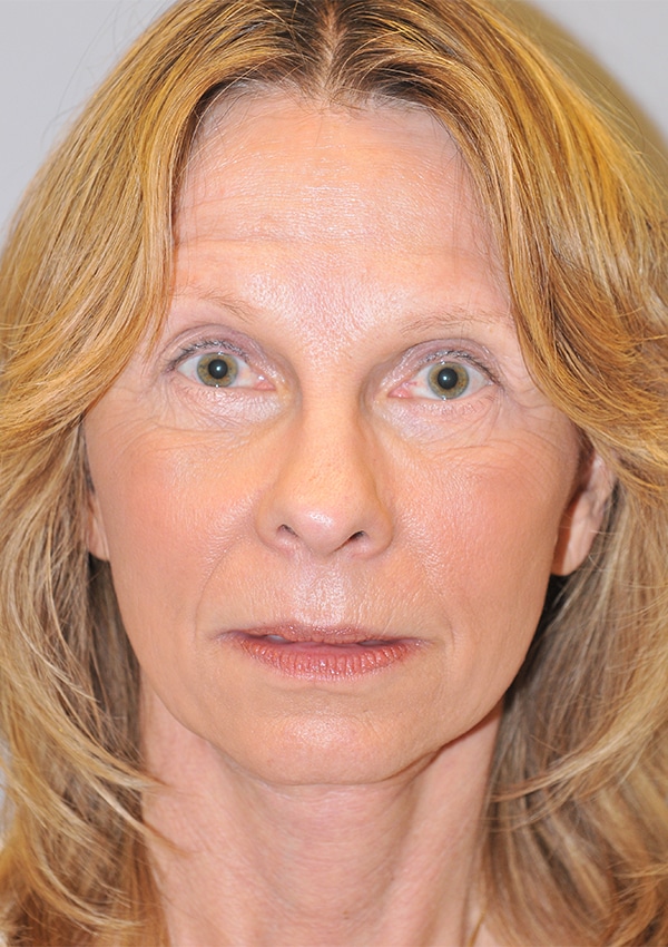 After Image: Facelift, Necklift and Lower Blepharoplasty - front