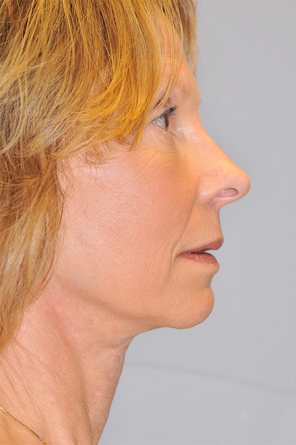 After Image: Facelift, Necklift and Lower Blepharoplasty - right-side