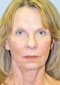 Facelift, Necklift and Lower Blepharoplasty