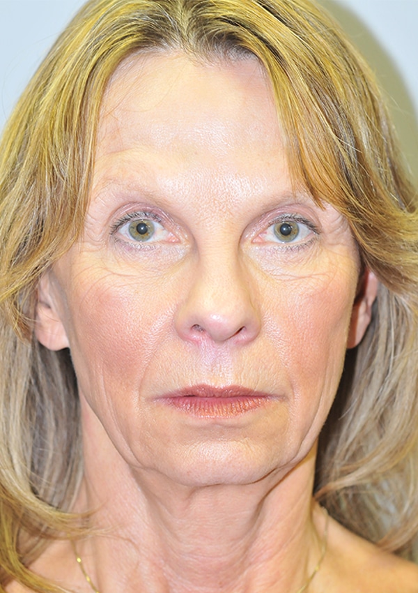 Before Image: Facelift, Necklift and Lower Blepharoplasty - front