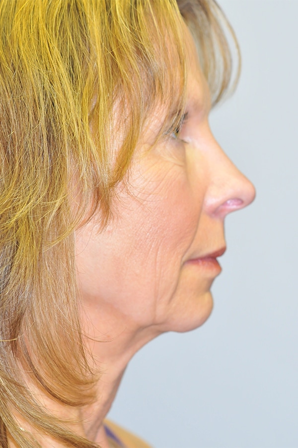 Before Image: Facelift, Necklift and Lower Blepharoplasty - right-side