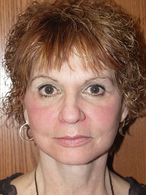 Facelift, Necklift, Upper & Lower Blepharoplasty, Ptosis Repair, and Endoscopic Browlift