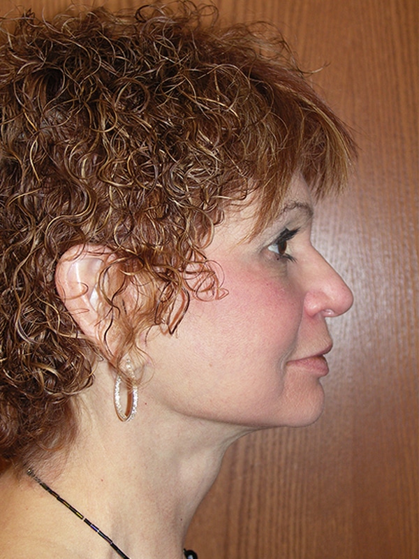 After Image: Facelift, Necklift, Upper & Lower Blepharoplasty, Ptosis Repair, and Endoscopic Browlift - right-side