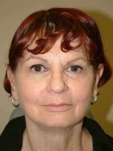 Facelift, Necklift, Upper & Lower Blepharoplasty, Ptosis Repair, and Endoscopic Browlift