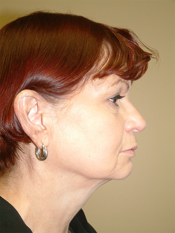 Before Image: Facelift, Necklift, Upper & Lower Blepharoplasty, Ptosis Repair, and Endoscopic Browlift - right-side