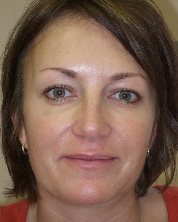 After Image: Orbital Cellulitis - front