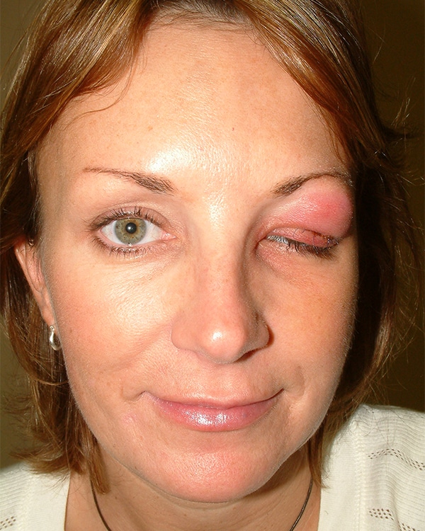 Before Image: Orbital Cellulitis - front
