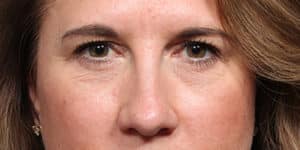 Upper & Lower Blepharoplasty