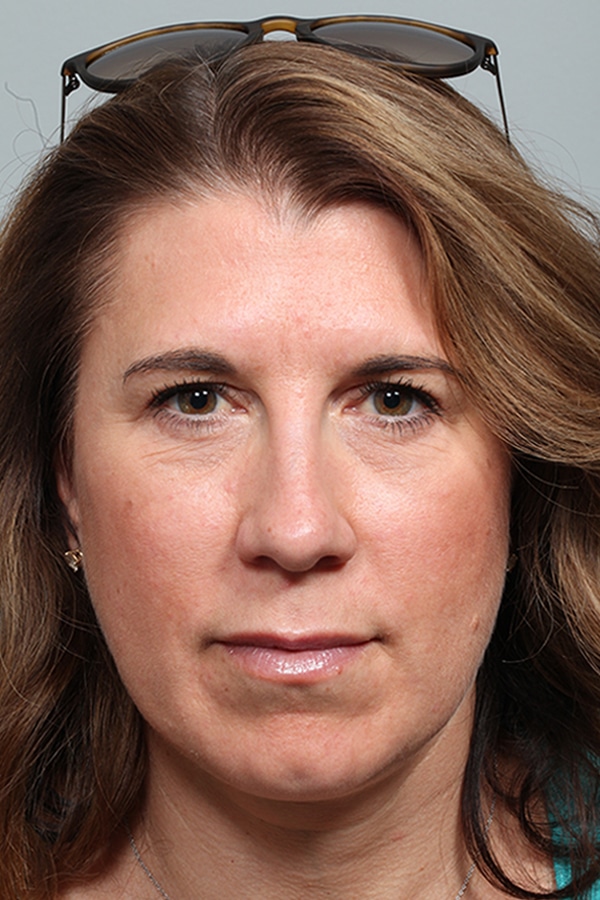 After Image: Upper & Lower Blepharoplasty - front