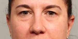 Upper & Lower Blepharoplasty