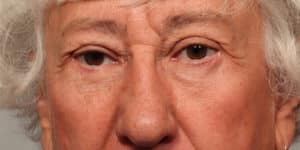 Upper & Lower Blepharoplasty