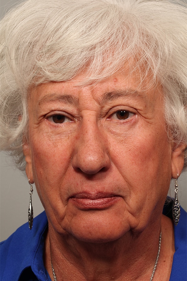 After Image: Upper & Lower Blepharoplasty - front