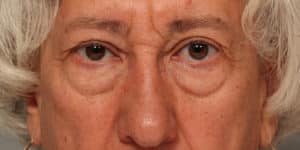 Upper & Lower Blepharoplasty