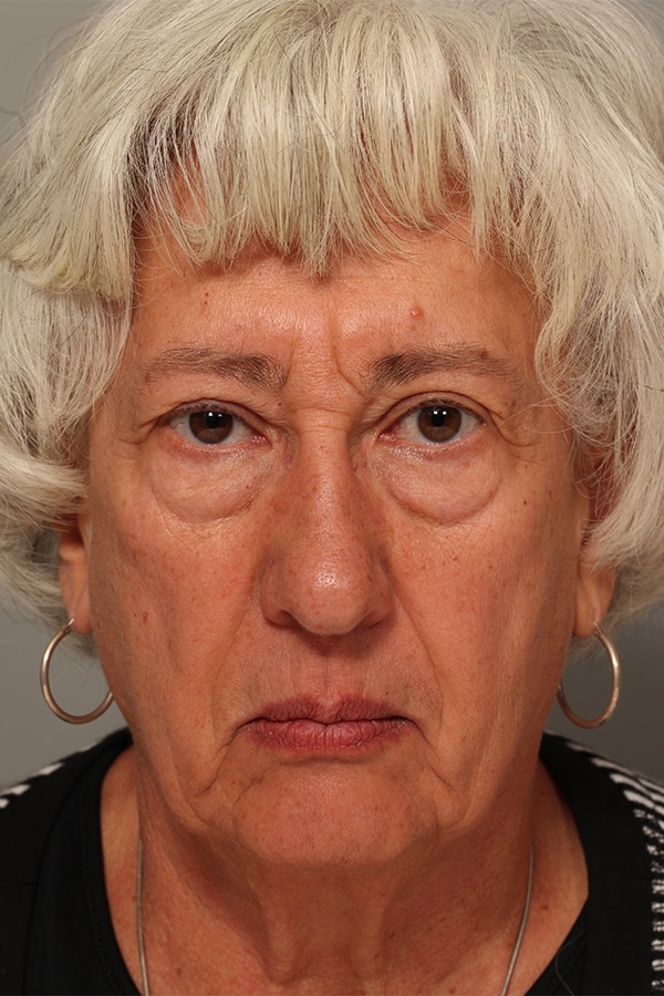 Before Image: Upper & Lower Blepharoplasty - front