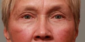 Upper & Lower Blepharoplasty