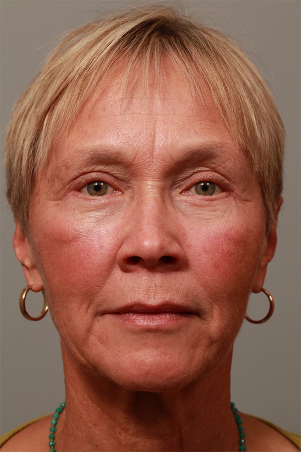 After Image: Upper & Lower Blepharoplasty -