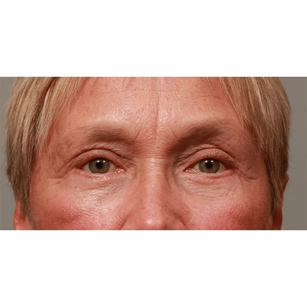 After Image: Upper & Lower Blepharoplasty - front