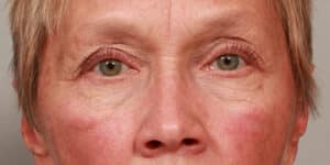 Upper & Lower Blepharoplasty