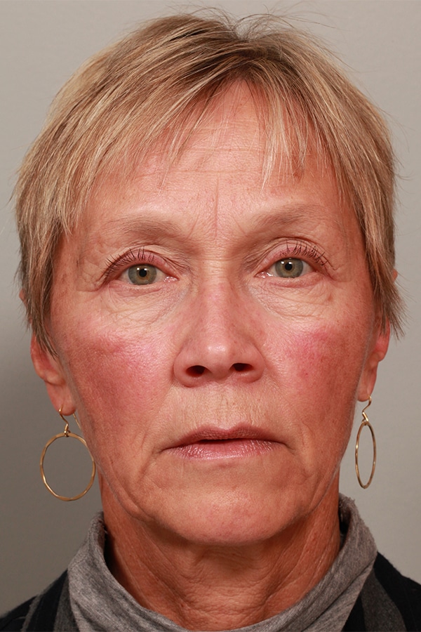 Before Image: Upper & Lower Blepharoplasty -