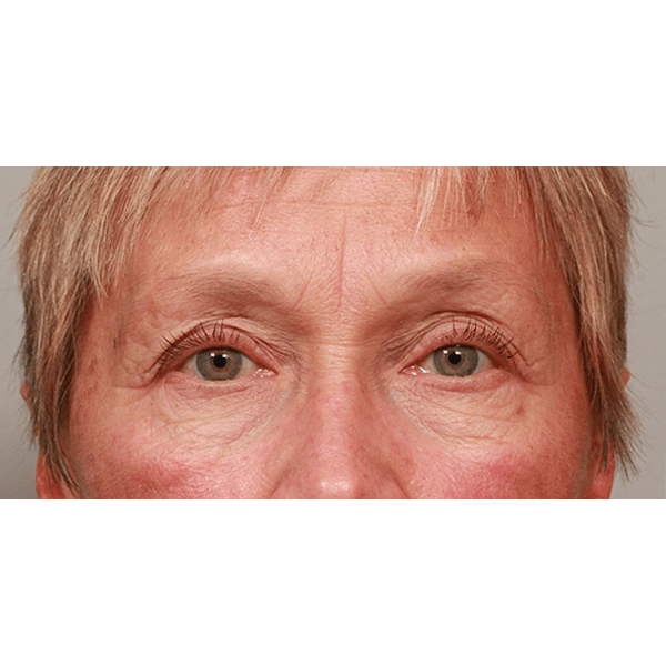 Before Image: Upper & Lower Blepharoplasty - front