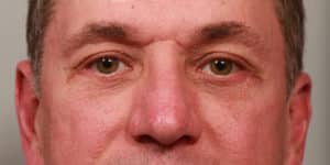 Lower Blepharoplasty