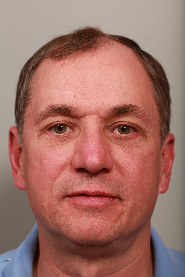 After Image: Lower Blepharoplasty - front