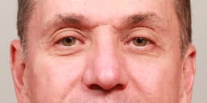 Lower Blepharoplasty