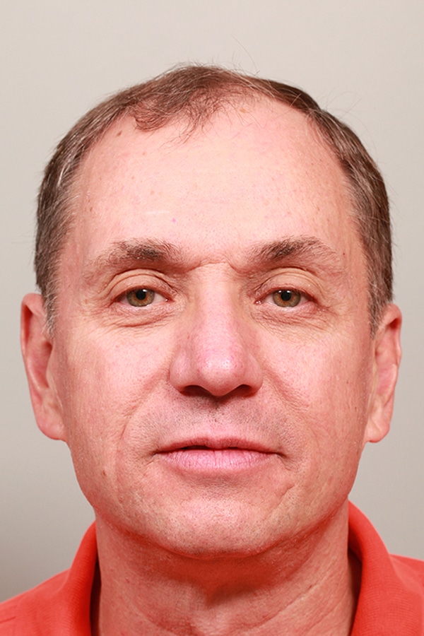 Before Image: Lower Blepharoplasty - front