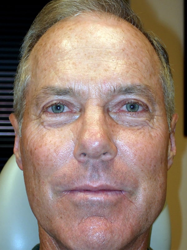 After Image: Upper Blepharoplasty - front