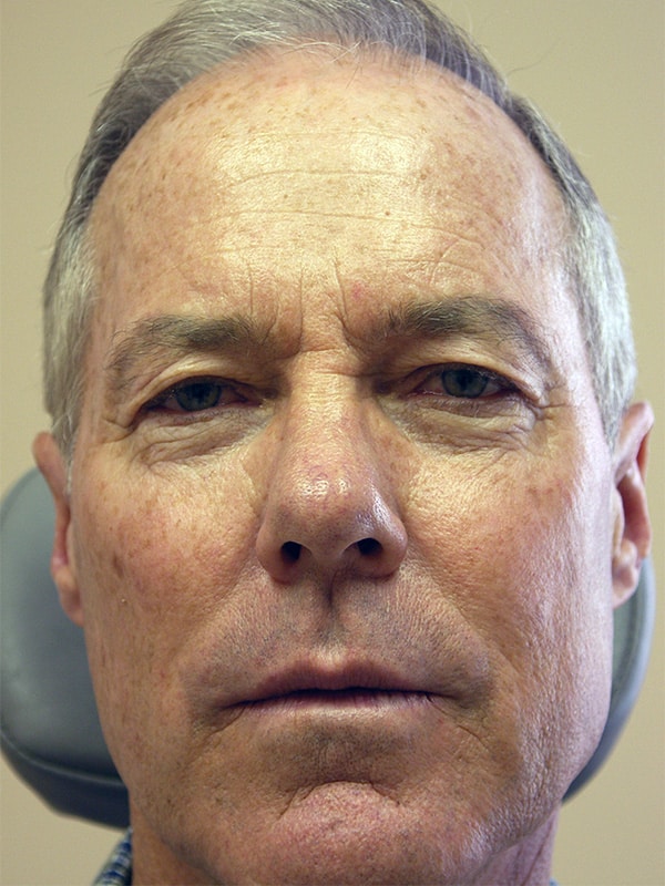 Before Image: Upper Blepharoplasty - front