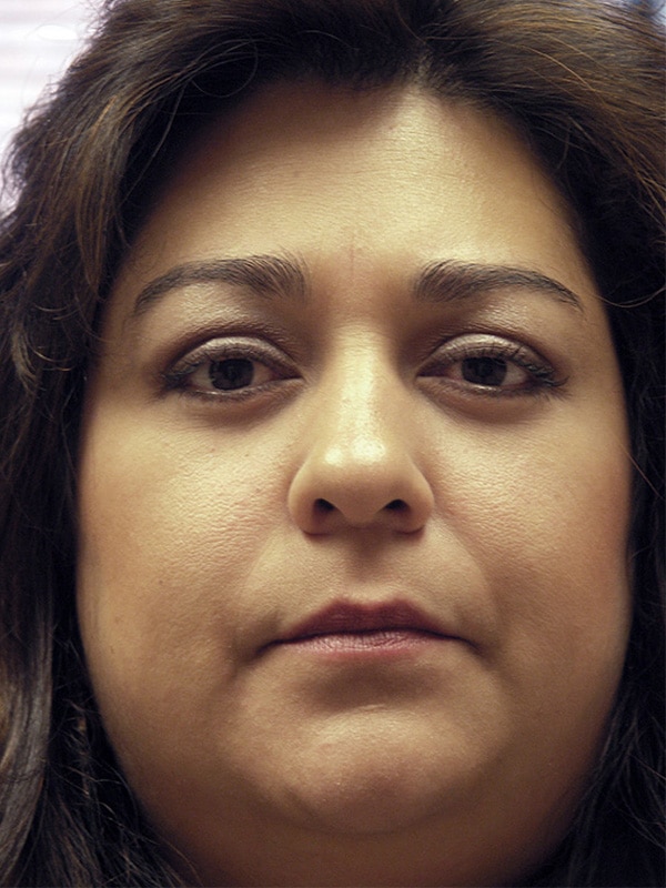 After Image: Thyroid Eye Disease (Graves’) - front