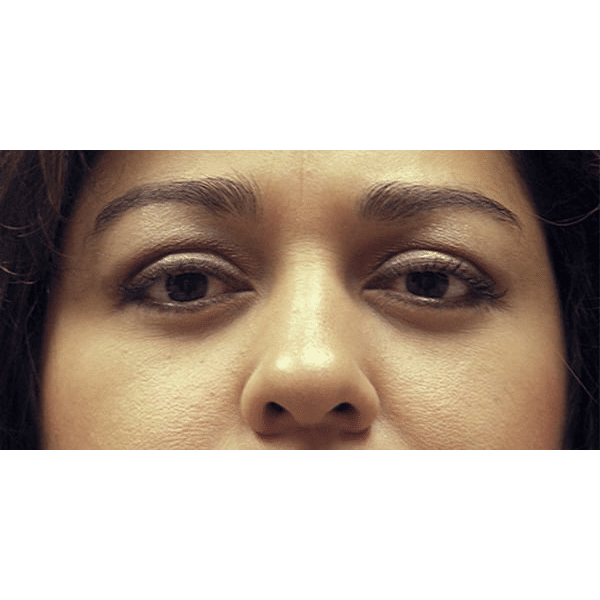 After Image: Thyroid Eye Disease (Graves’) - front