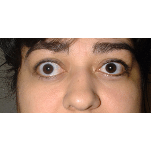 Before Image: Thyroid Eye Disease (Graves’) - front