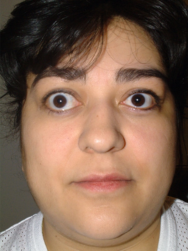 Before Image: Thyroid Eye Disease (Graves’) - front