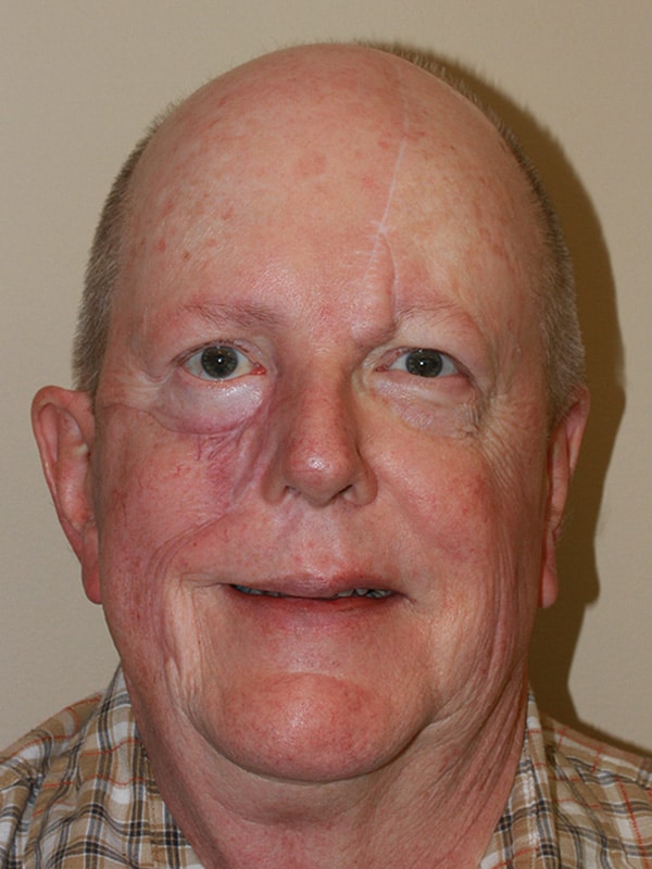 After Image: Facial Reconstruction - front