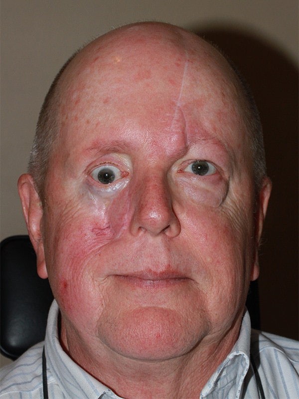 Before Image: Facial Reconstruction - front