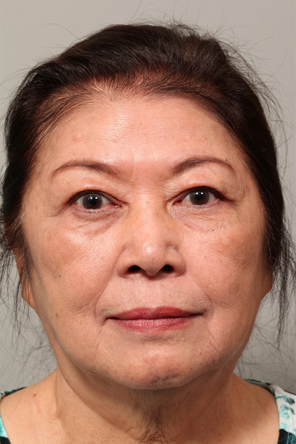 After Image: Asian Blepharoplasty - front