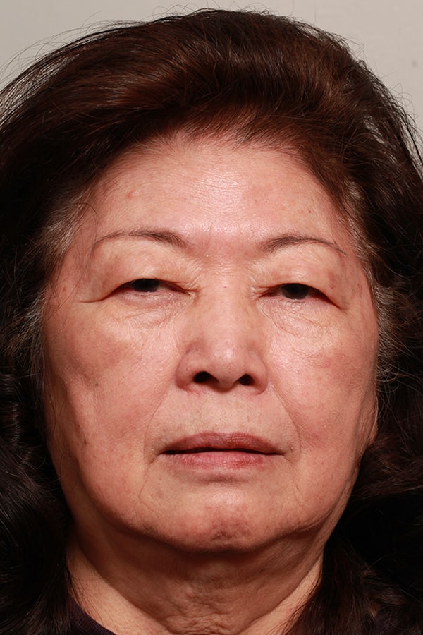 Before Image: Asian Blepharoplasty - front