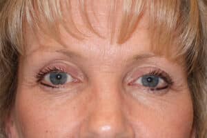 Upper Blepharoplasty