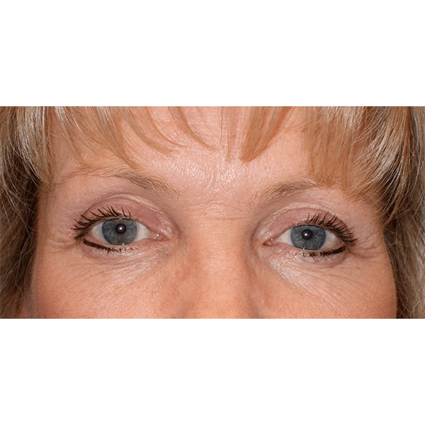 After Image: Upper Blepharoplasty - front