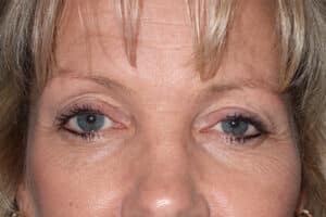 Upper Blepharoplasty
