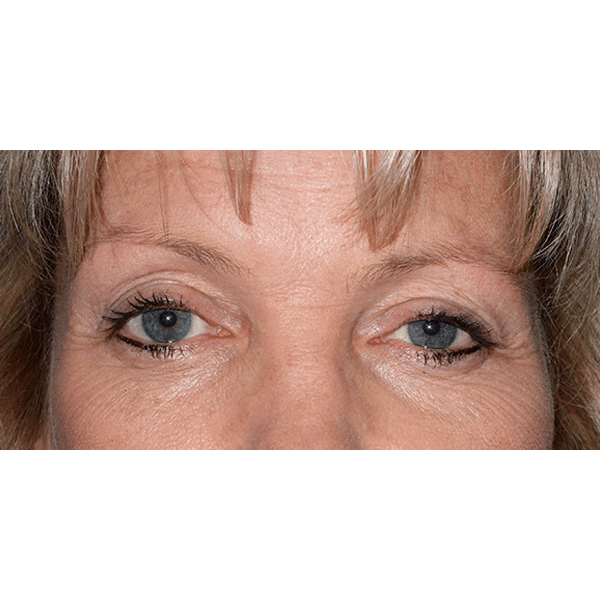 Before Image: Upper Blepharoplasty - front