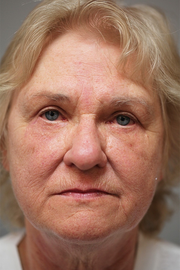 After Image: Upper & Lower Blepharoplasty - front