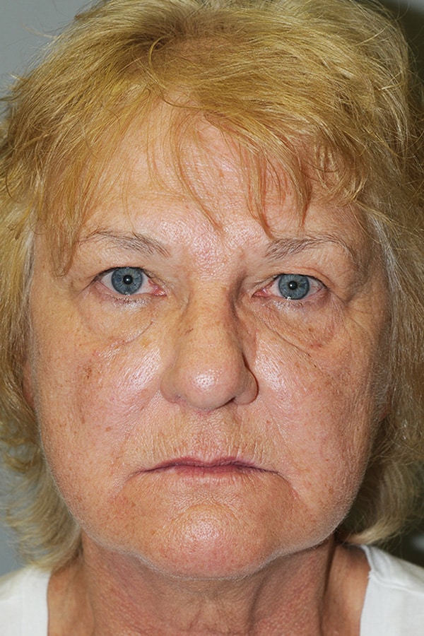 Before Image: Upper & Lower Blepharoplasty - front