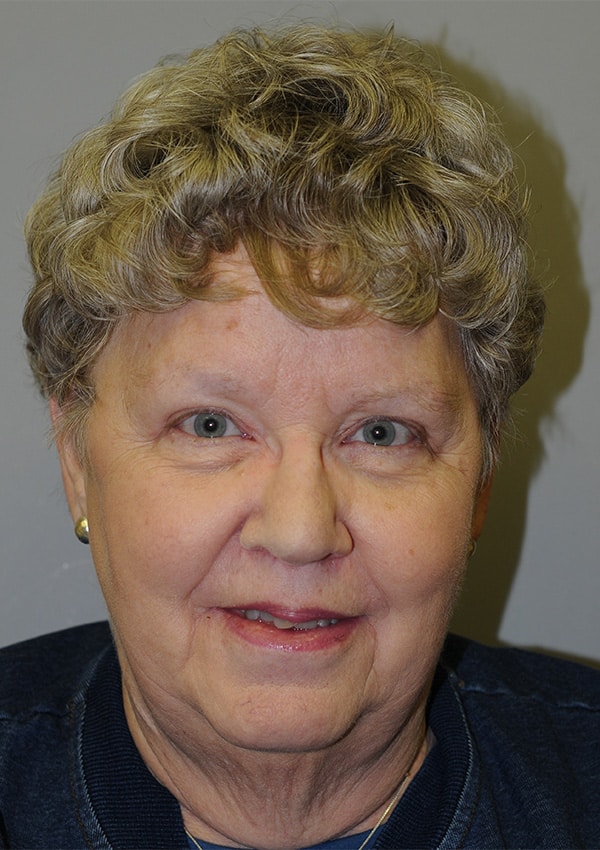 After Image: Upper Blepharoplasty and Ptosis Repair - front
