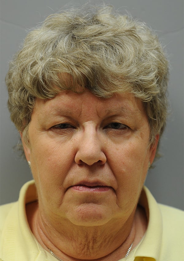 Before Image: Upper Blepharoplasty and Ptosis Repair - front