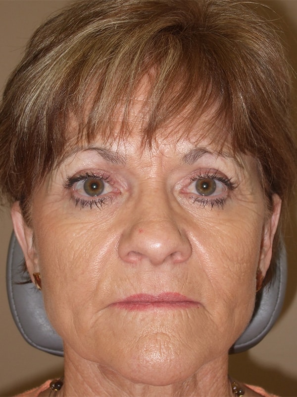 After Image: Right Ptosis Repair - front